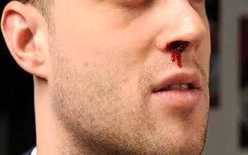 علل ابتلا به خون دماغ| 2 دلیل عمده کدام است؟ 