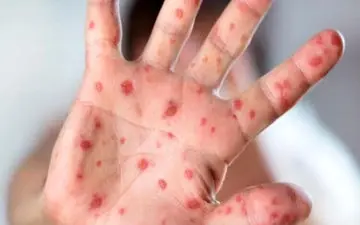 زنگ خطر شیوع سرخک به صدا در آمد

