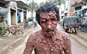 مردی با یک بیماری پوستی نادر 