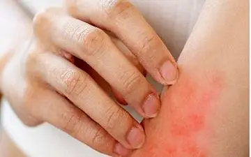 جایگزین های امن برای خاراندن| هنگام خارش ناشی از اگزما چکار کنم؟