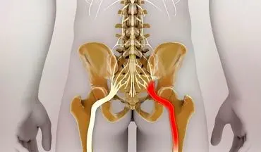 آموزش حرکات اصلاحی ساده برای تسکین درد سیاتیک (+ویدئو)