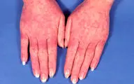 بیماری پوستی شایع | درگیری سیستم ایمنی با این بیماری