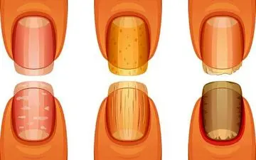 ناخن‌هایتان بیماری‌تان را آشکار می‌کند!