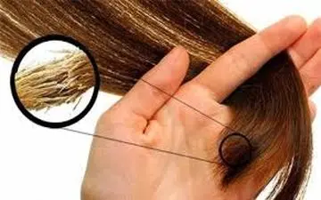 راهکارهایی کلیدی برای پیشگیری از موخوره