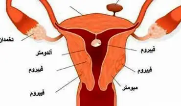 مهمترین دانستنی ها در مورد فیبروم رحمی!