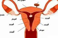 مهمترین دانستنی ها در مورد فیبروم رحمی!