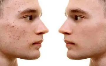 برای جلوگیری از جوش صورت این کارها را بکنید!