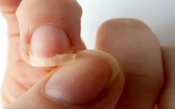 ریزش مو و ناخن شکننده را جدی بگیرید