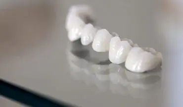 روکش دندان چیست و مراحل انجام آن چگونه است؟