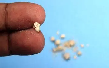 بهترین روش درمانی انواع سنگ کلیه 