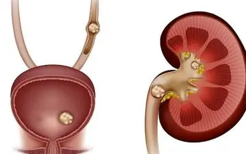 با این موارد دم دستی سنگ کلیه را پودر کنید