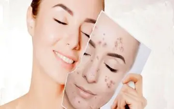 روش‌های خانگی برای درمان سریع جوش و التهاب پوست صورت