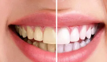 زیبایی دندان با روش ساده و خانگی | رفع جرم و پلاک دندان با پوست گردو