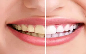 زیبایی دندان با روش ساده و خانگی | رفع جرم و پلاک دندان با پوست گردو