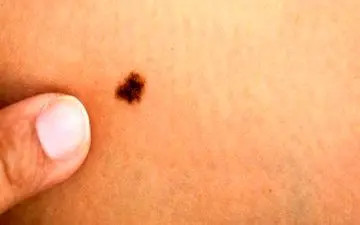 خال‌های خطرناک بدن کدامند؟

