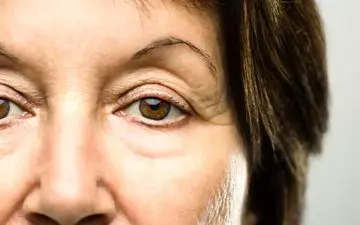  پرش پلک چشم به چه علت است؟