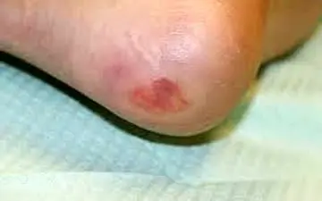 اختراع  اسپری ضدعفونی‌کننده‌ برای زخم های دیابتی ها!