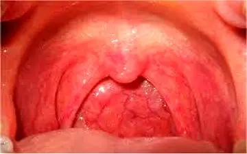 آشنایی با بیماری ویروسی در کودکان

