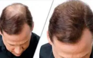 ۴ میوه مغذی که برای رشد مو مفید است