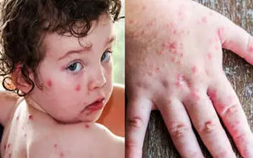 
تب گوجه‌فرنگی چیست؟