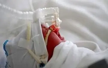 ویروس "RSV" چیست؟