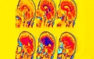 تاثیر جالب توجه ۲ واکسن بر جلوگیری از زوال عقل