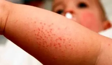 در مورد بیماری سپسیس چه می دانید؟