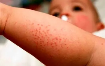 در مورد بیماری سپسیس چه می دانید؟