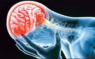 ارتباط آسیب نخاعی و افزایش خطر سکته مغزی