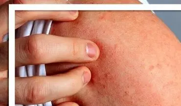 چرا استرس باعث بروز کهیر می شود؟