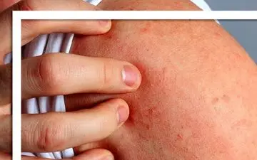 چرا استرس باعث بروز کهیر می شود؟