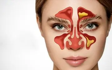 سینوزیت درمان نشود،کشنده است!