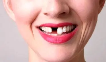 تعبیر دیدن افتادن دندان در خواب چیست؟ | تعبیر خواب افتادن دندان