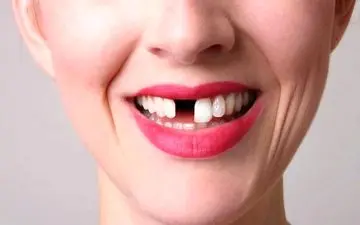 تعبیر دیدن افتادن دندان در خواب چیست؟ | تعبیر خواب افتادن دندان