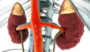  هورمونی وجود دارد که می تواند به سلامت کلیه های شما آسیب وارد کند!