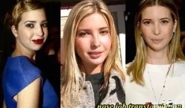 «ایوانکا ترامپ» قبل و بعد از عمل زیبایی + تصاویر