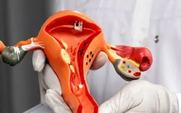 تا چه میزان سندروم تخمدان پلی‌کیستیک ارثی است؟