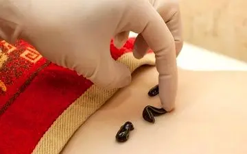 آنچه که باید از زالودرمانی بدانید