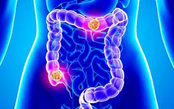 تهدیدی بزرگ در کمین فست فود خورها + فیلم