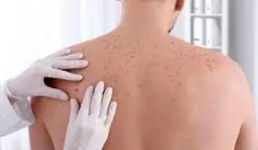  سرطان پوست چیست؟چه وقت باید نگران باشیم؟ علل، پیشگیری و رژیم غذایی