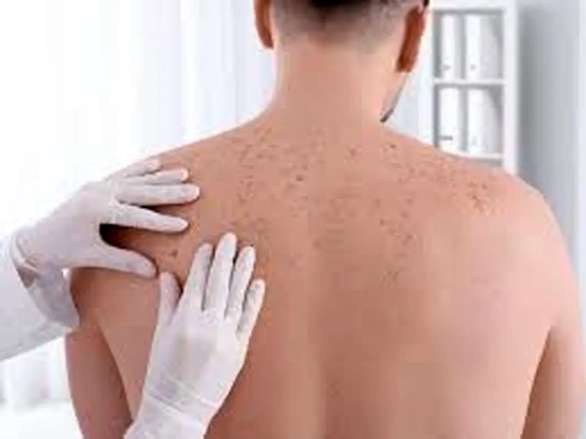  سرطان پوست چیست؟چه وقت باید نگران باشیم؟ علل، پیشگیری و رژیم غذایی