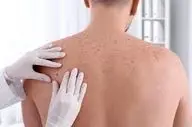  سرطان پوست؛ علل، پیشگیری و رژیم غذایی