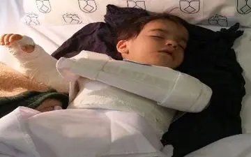 اشتباه فجیع پزشکی/دست چپ کودک اصفهانی به جای دست راستش جراحی شد ! 