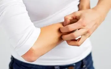 6 روش خانگی برای تسکین پشه گزیدگی