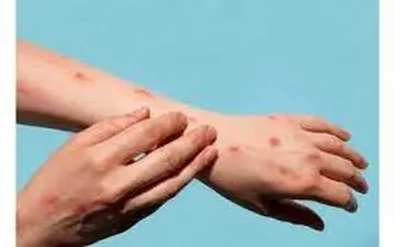 مطمئن ترین راه برای پیشگیری از آبله میمون