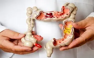 چند راهکار طب سنتی برای درمان یبوست

