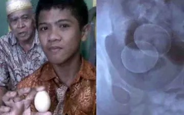 پسری که مانند مرغ، تخم می‌گذارد!