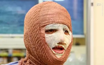 آیا بهبود کامل پس از سوختگی‌های عمیق امکان‌پذیر است؟