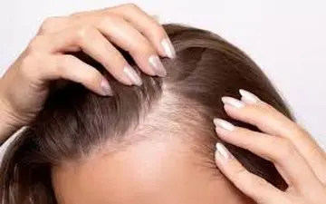 اگر  ریزش مو  دارید حتما بخوانید!