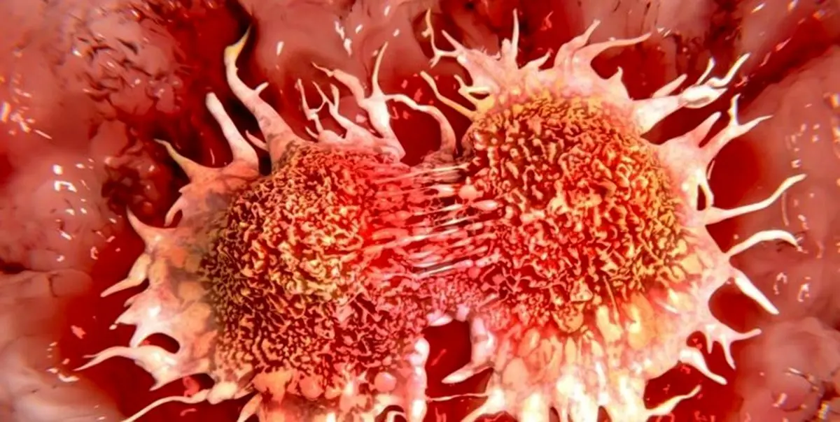 «سرطان تخمدان»؛ هزاران زن در معرض 